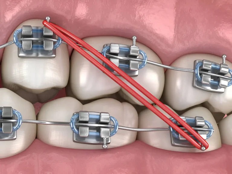 All-on-4 Dental Implants The Complete Guide to Restoring Your Smile